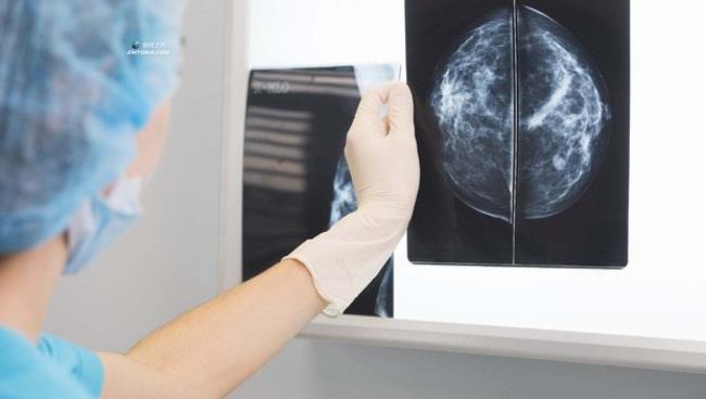 乳腺癌:如何提前发现