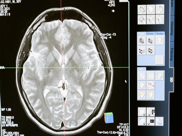 识别脑细胞之间重要联系的新方法:研究